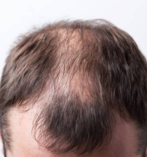 Alopecia