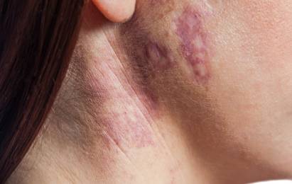 Autoimmune Skin Diseases
