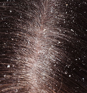 Dandruff & Dry Scalp