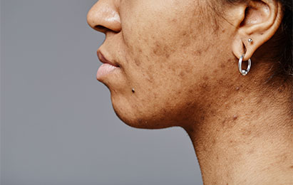 Pigmentation Disorders
