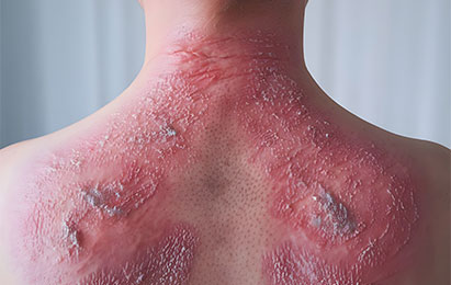 Psoriasis