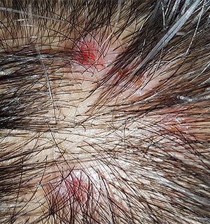 Scalp Psoriasis