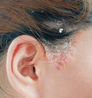 Seborrheic Dermatitis