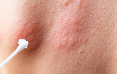 Viral Skin Infections